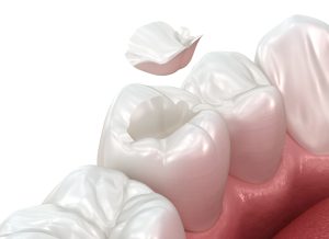 tooth colored fillings in dacula