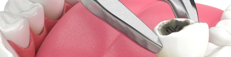 Tooth Extraction 101: What to Expect Before, During, and After