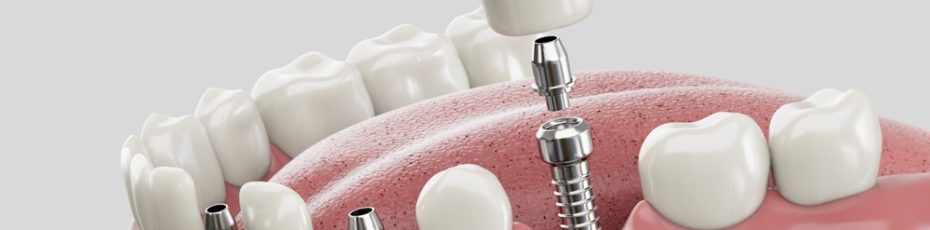 What Are Dental Implants and How Do They Work?