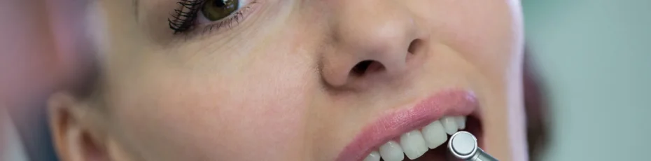 tooth colored fillings